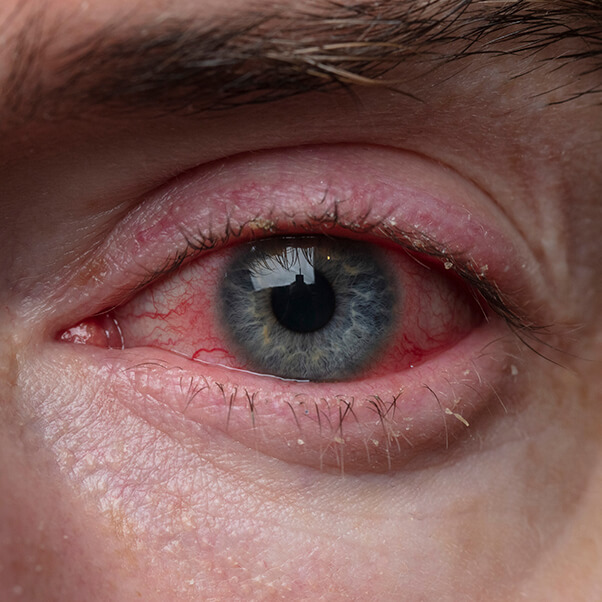 Closeup of an Eye With Conjunctivitis