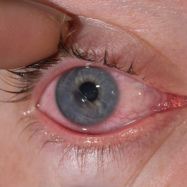 Corneal Abrasion